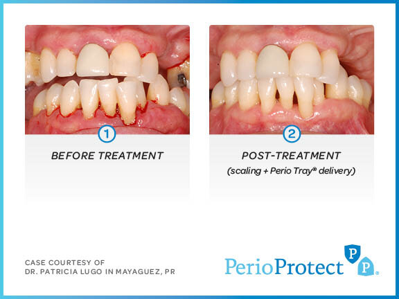 Perio-Protect-Case-Studies9_web.jpg